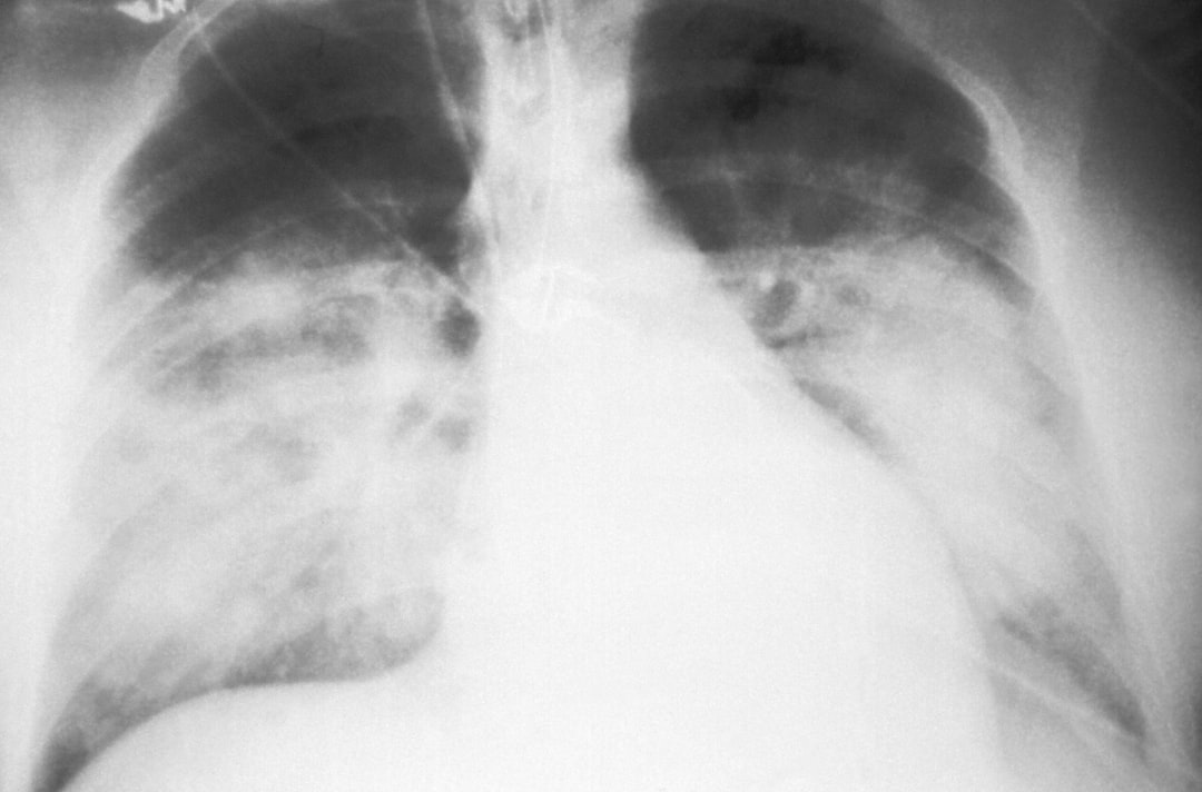 Neill’s Says Pneumonia Caused: A Personal Finance Guide