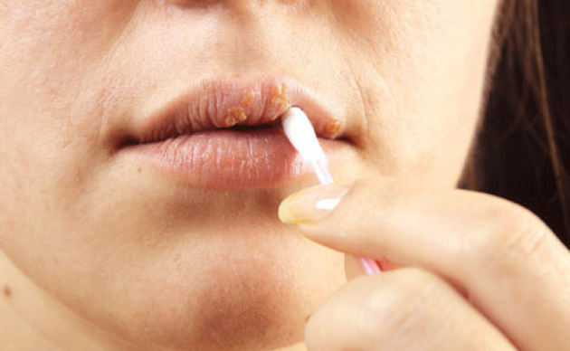 Cum luptăm împotriva herpesului