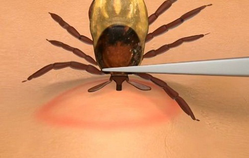 Cum scoti usor o capusa din piele