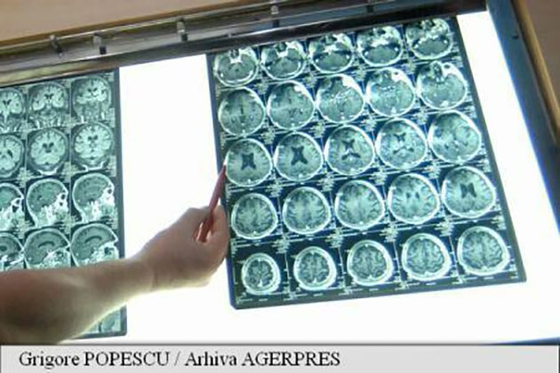 Maladia Parkinson ar putea fi legată de numeroase forme de cancer