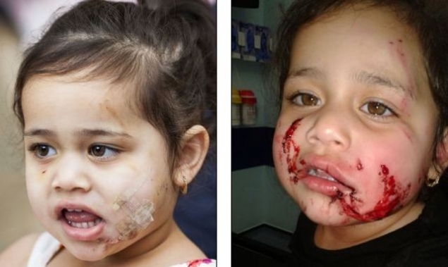 DESFIGURATĂ de CÂINELE bunicilor. O FETIŢĂ de doar 2 ANI a fost la un pas de MOARTE