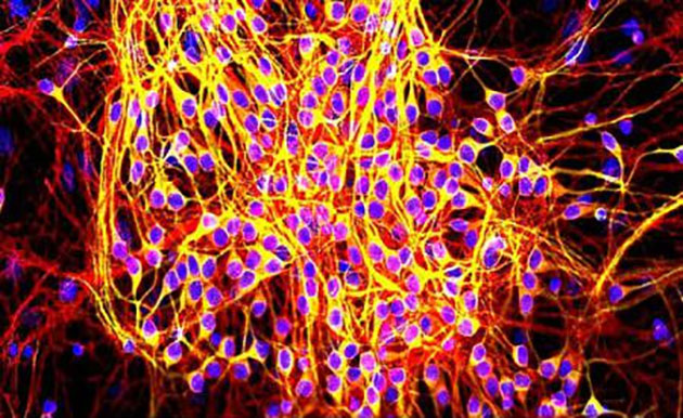 Un compus chimic înrudit cu aspirina i-ar putea ajuta pe bolnavii de Alzheimer