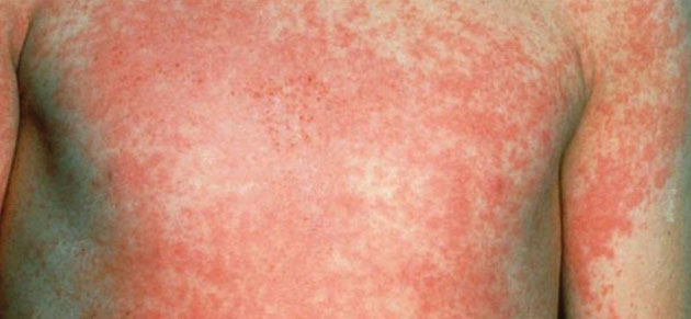 Suspecţi de scarlatină la Şcoala “Grigore Moisil”