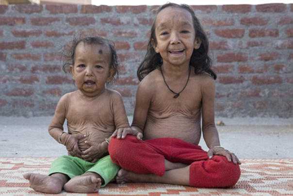 Imagini CUTREMURĂTOARE: Boala care transformă copiii în bătrâni