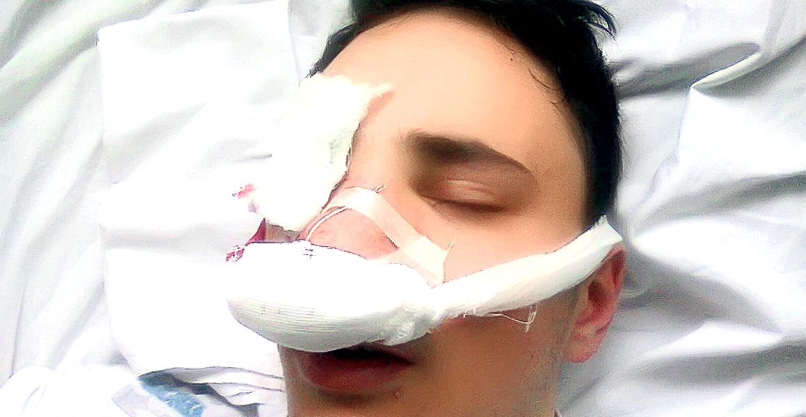 Minor, desfigurat de o petardă. Acum e în spital