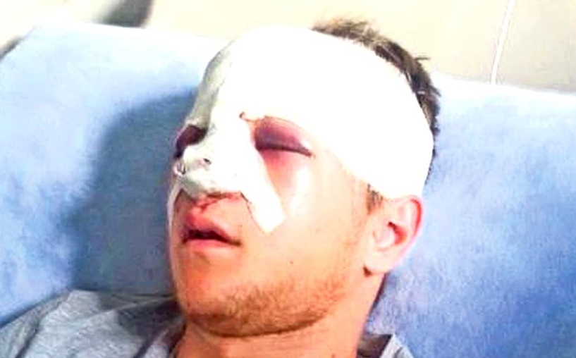 DESFIGURAT de o petardă. Victima, internată în spital