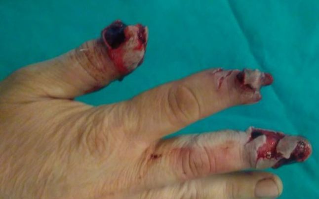 MUTILAȚI de REVELION. O femeie, la un pas să-și PIARDĂ VEDEREA