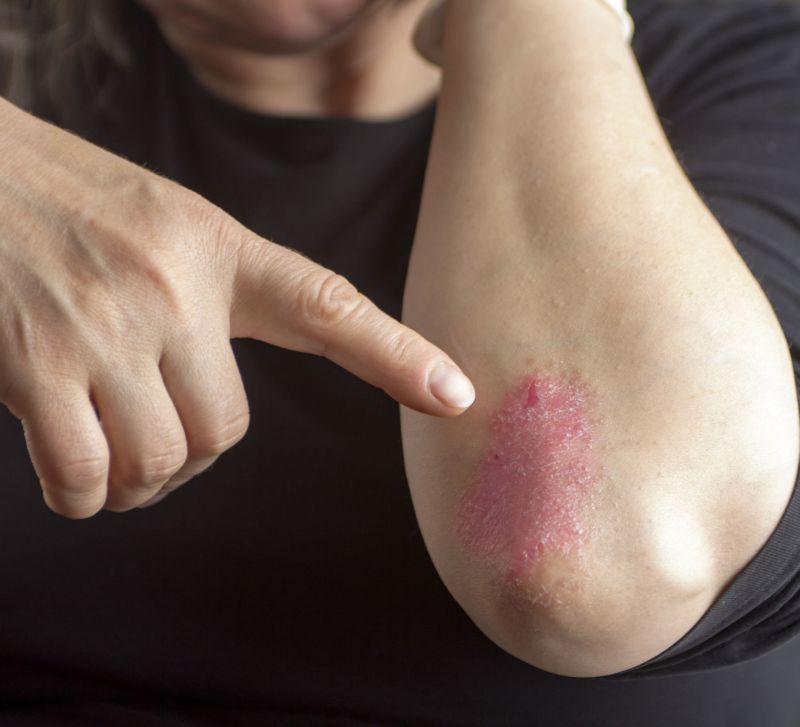 DERMATOLOGIE. Factorii psihologici, elementele majore în apariția psoriazisul