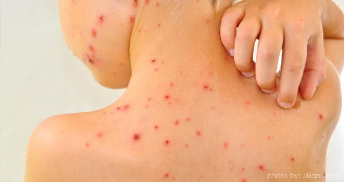 Alarmă la nivel NAȚIONAL:  Ministerul Sănătății a declarat epidemie de rujeolă