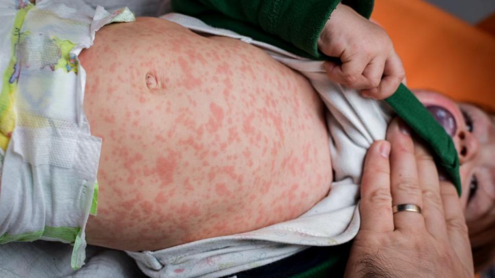 ALERTĂ SANITARĂ!!! În județul Satu Mare au fost înregistrate 17 cazuri de rujeolă în septembrie